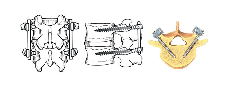 La colonna vertebrale, o il tratto di interesse, viene “stabilizzato” con l’ausilio di  barre di titanio a loro volta ancorate alla colonna vertebrale a mezzo di viti che  vengono inserite nelle vertebre attraverso un tratto molto piccolo chiamato “peduncolo”. 
