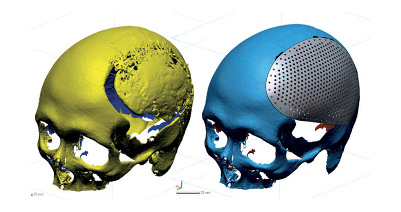2. Modellazione semi-automatica di placche craniche. 
